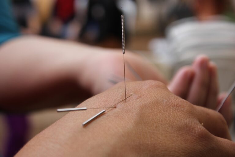 Akupunktura fizjoterapia Skuteczna fizjoterapia