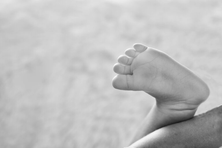 Płaskostopie u dzieci fizjoterapia Ćwiczenia na płaskostopie fizjoterapia